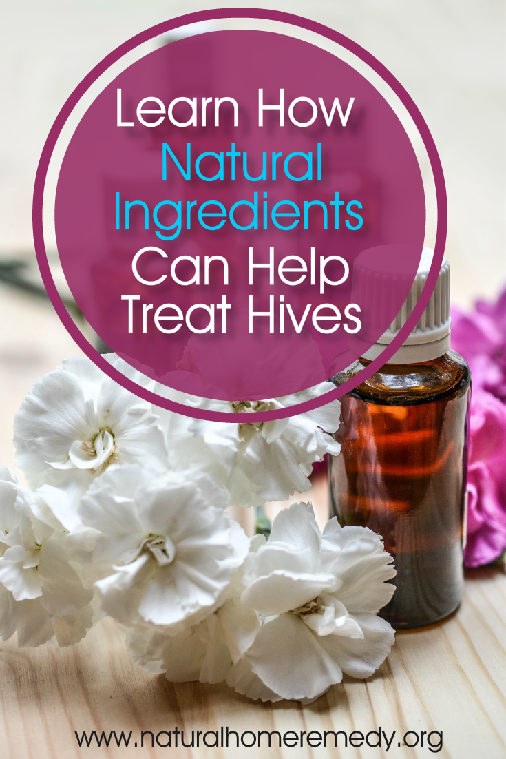 How To Get Rid Of Hives Fast At Home