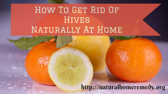 hives treatment home remedies