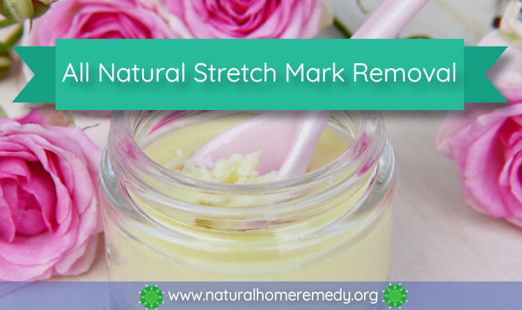 stretch mark home remedy