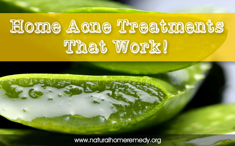 acne natural home treatments