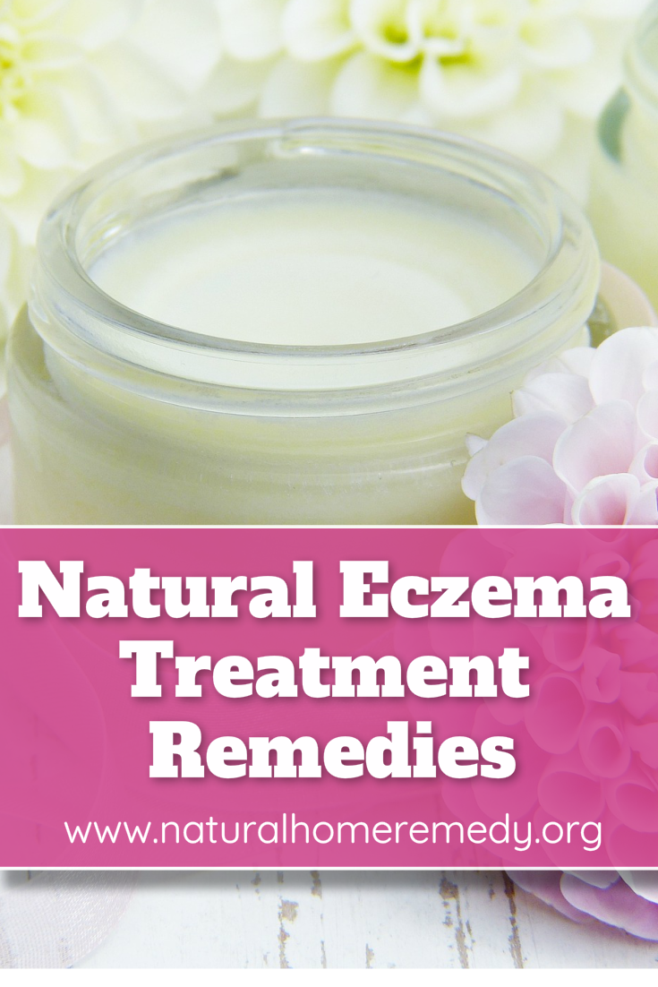 eczema home remedy treatment